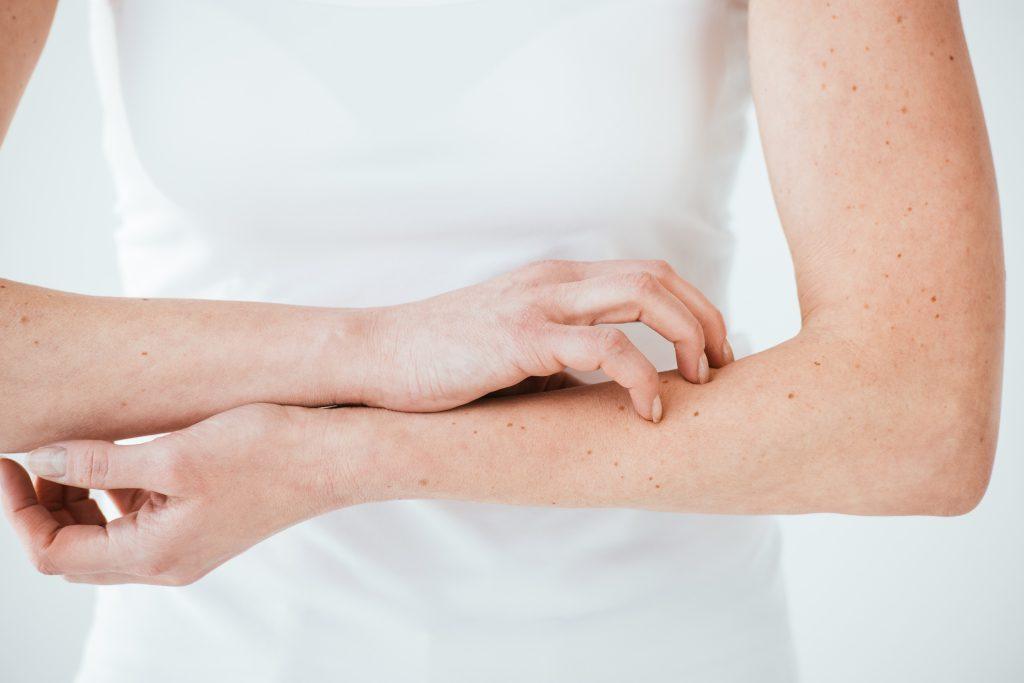 Cropped view of the arms of a woman that is scratching her skin, indicating allergies.